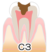 虫歯の進行について