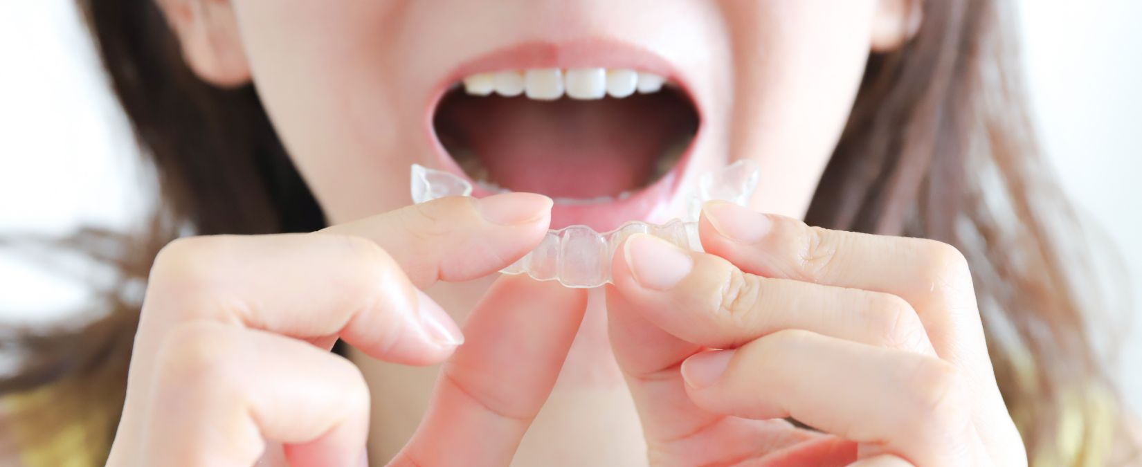 矯正歯科治療に伴う一般的なリスクや副作用について